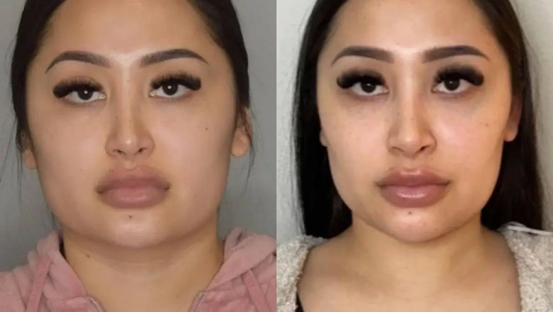 Buccal Fat Removal for Younger-Looking Skin: Best Doctors in Dubai Share Insights
