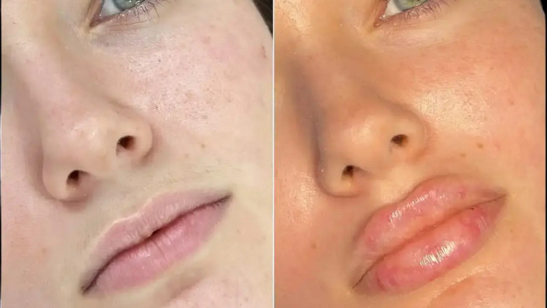 Best Doctors in Dubai for Fillers for Every Skin Type