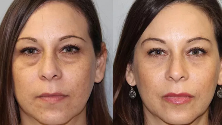 Eyelid Bag Surgery Dubai: What You Need to Know Before the Procedure