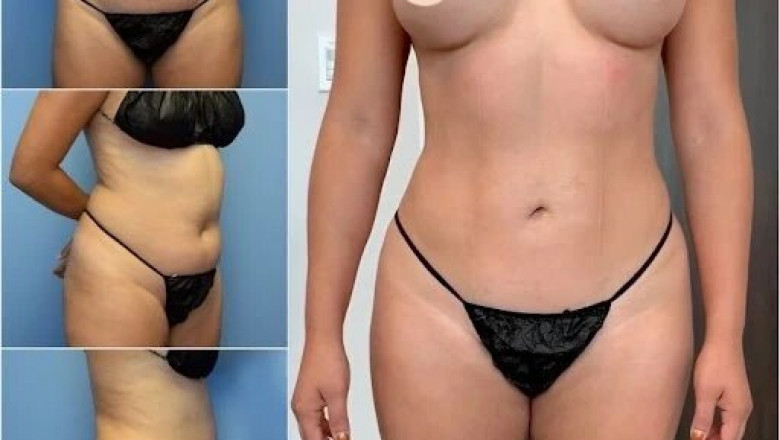 How the Best Body Contouring Surgeons in dubai Use Advanced Techniques