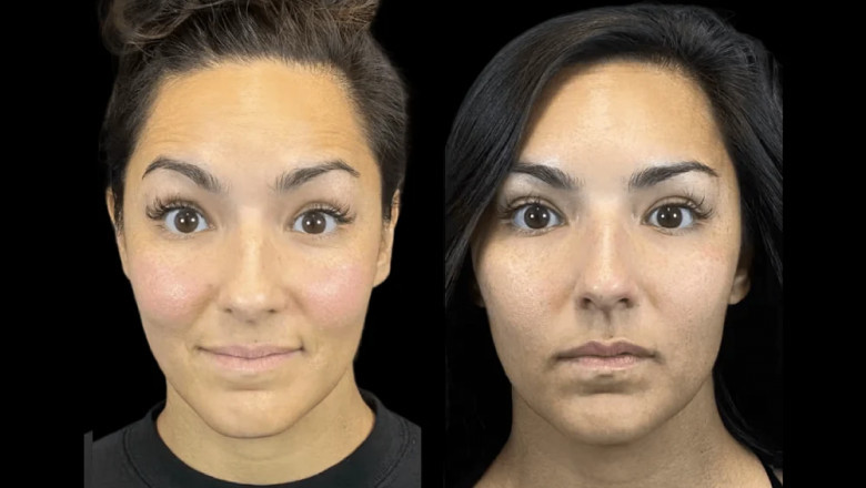 The Role of Botox in Preventative Skincare According to the Best Doctors in dubai