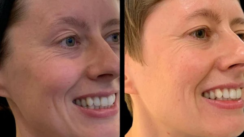 Best Aesthetic Clinics in Dubai: How Profhilo Can Revitalize Your Skin