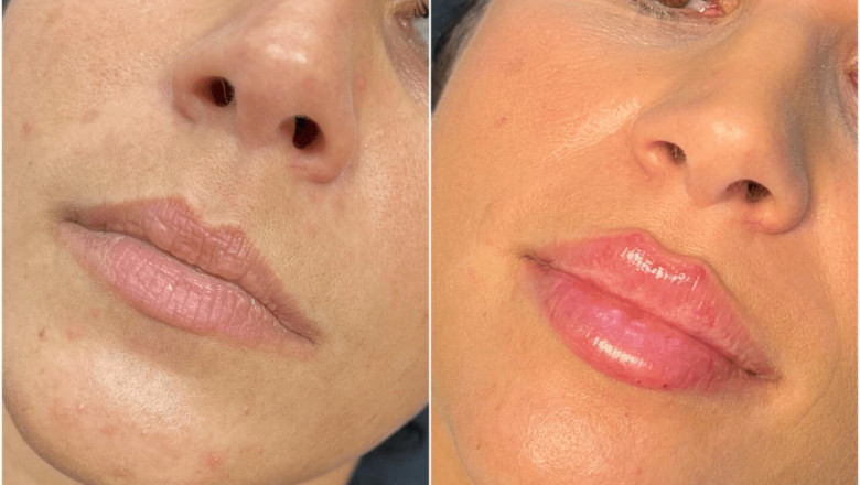 How Juvederm Can Transform Your Look: Services from the Best Aesthetic Clinics in dubai