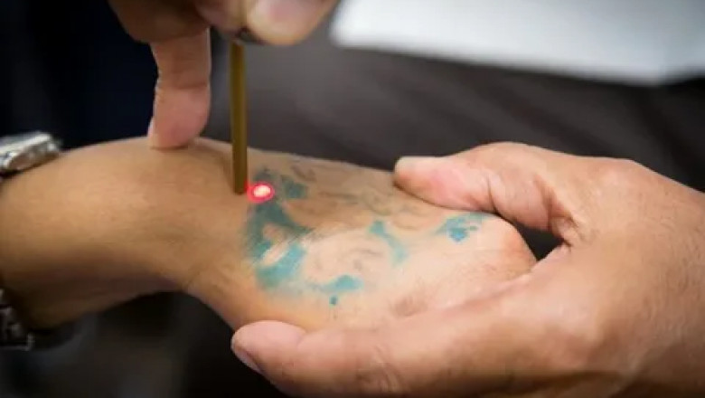 Laser Tattoo Removal in Los Angeles: Everything You Need to Know
