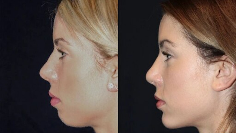 Best Plastic Surgeons in dubai for Chin Fillers: Enhancing Your Natural Features