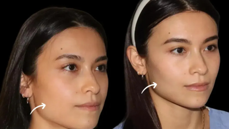 Ultimate Guide to Choosing the Best Plastic Surgeon in Dubai for Sculptra Fillers