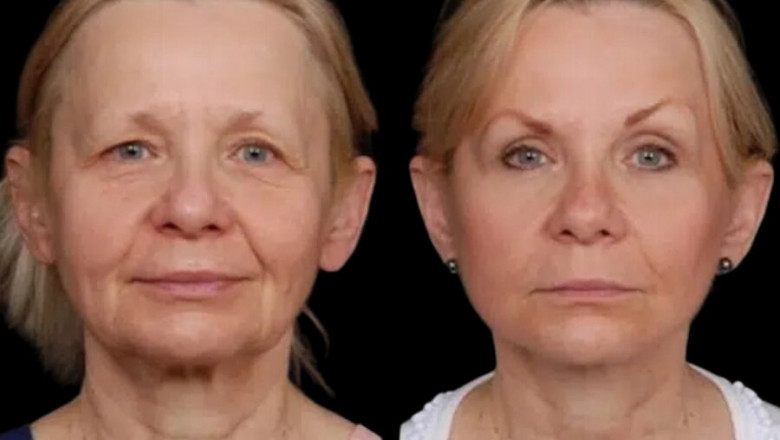 What Are the Signs That You Need Under Eye Fillers from Best Plastic Surgeon in Dubai?
