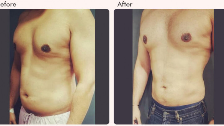 Fat removal surgery cost in Delhi - Dr Rajat Gupta