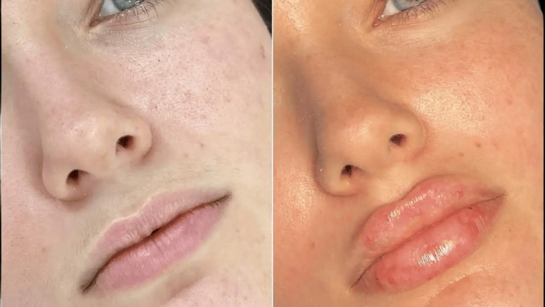 Best Doctors in Dubai for Fillers That Celebrities Trust