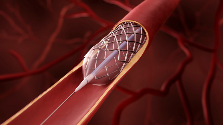 Drug Eluting Stents Market Growth and Strategic Outlook 2025-2032