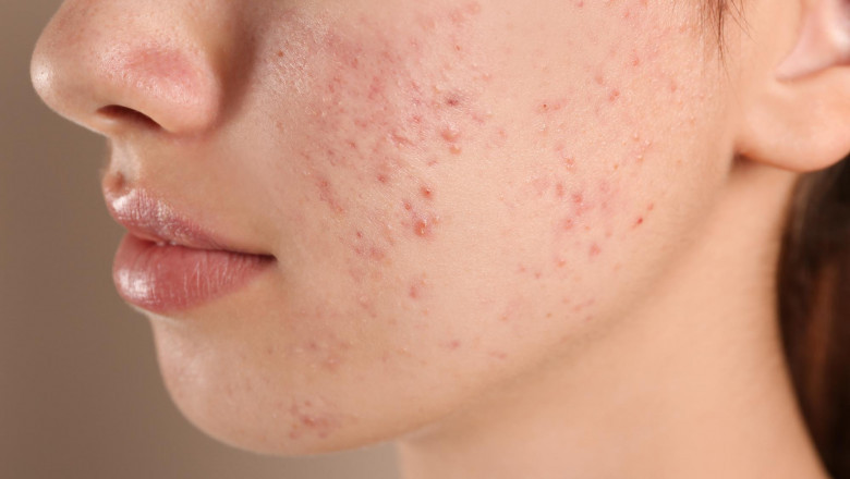 Understanding Acne: What It Really Is and Why It Happens