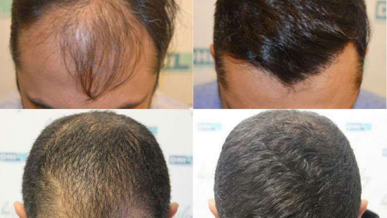 Discover Confidence Again: Hair Transplant in Bhubaneswar