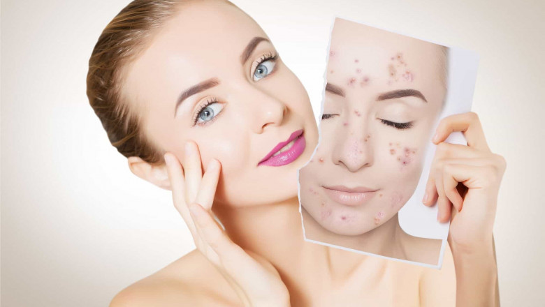 acne spot removal puchong