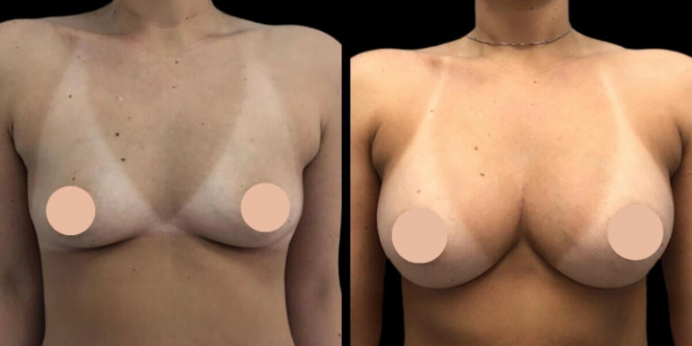 Natural-Looking Results: Breast Augmentation in Dubai Explained