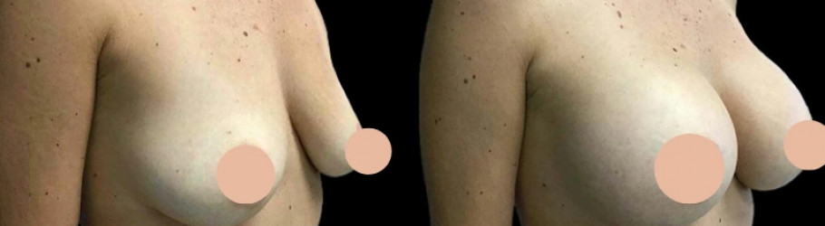 Breast Augmentation Surgeon