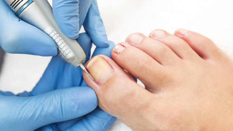 Top Ingrown Nail Scissors: Precision Tools for Pain-Free Nail