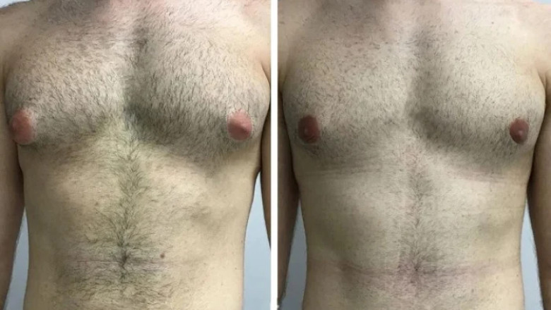 The Growing Awareness of Gynecomastia in Dubai: What You Need to Know