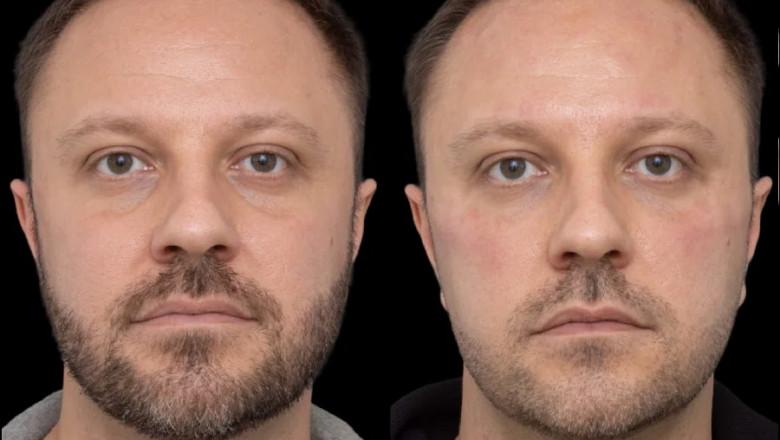 Post-Treatment Care for Under Eye Fillers in Dubai