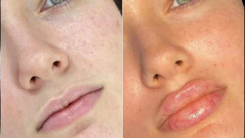Why Russian Lip Fillers in Dubai is the Perfect Solution for Lip Asymmetry