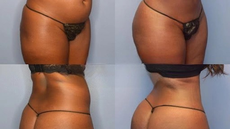 Ask Questions for Your Liposuction Surgery in Dubai