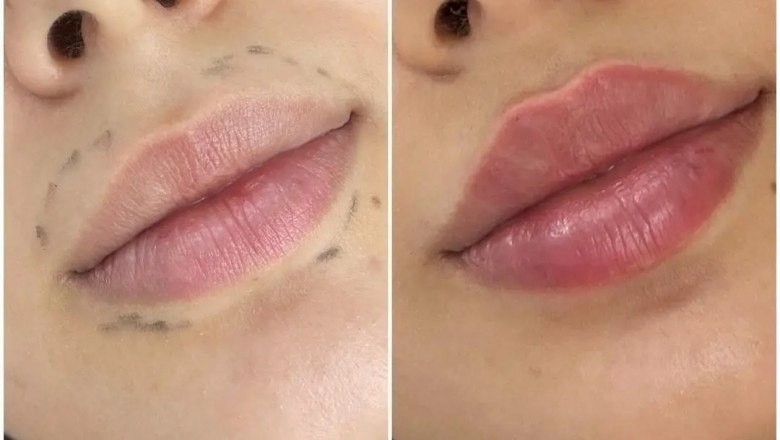 What to Expect When You Get Juvederm Fillers in Dubai: Tips from the Best Plastic Surgeon in dubai
