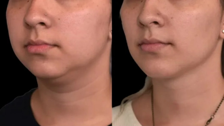 Double Chin Removal for Men: Advice from the Best Doctors in Dubai