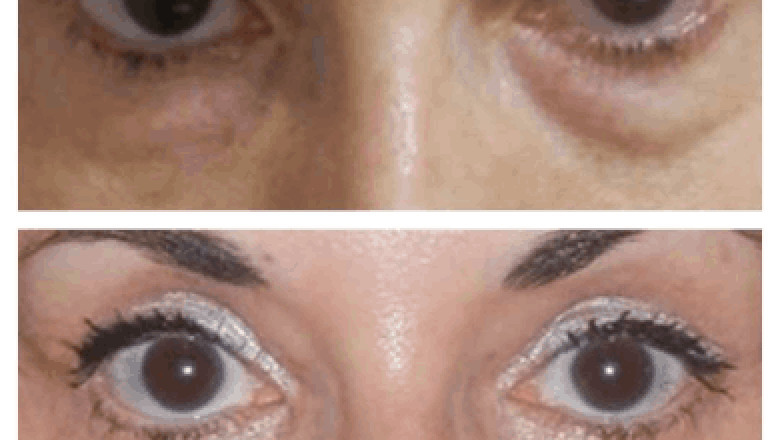 Natural-Looking Results from Eye Bag Removal: The Best Doctors in Dubai Share Tips