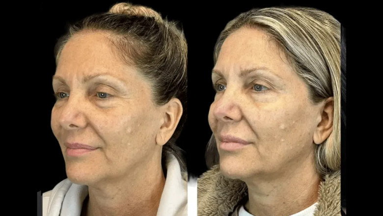 Best Doctors in dubai Reveal Botox Tips for First-Time Patients