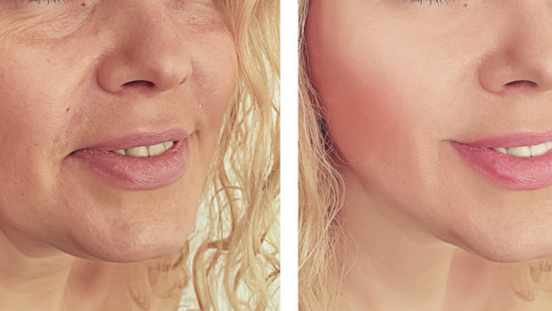 Delving into the World of 7D HIFU Facial Treatment