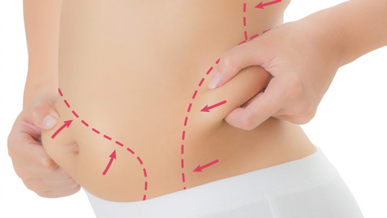 Dream Body Shape with Best Liposuction Surgeon in Dubai