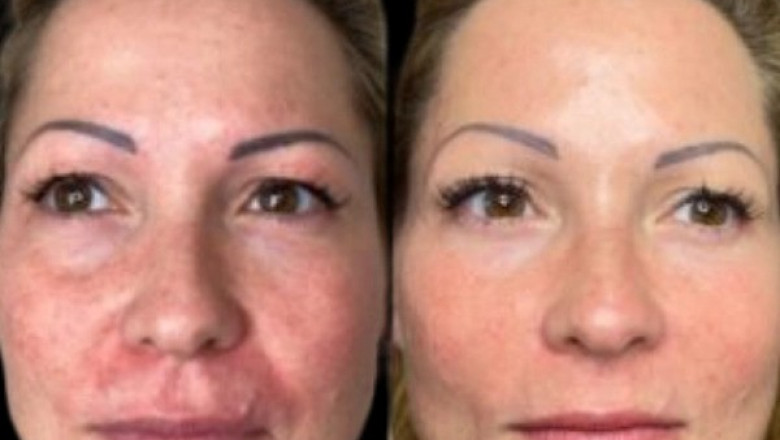 Is Profhilo the Best Choice for Wrinkles Insights from the Best Aesthetic Clinics in Dubai
