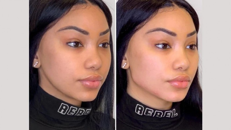 Top Benefits of Thread Lift at the Best Aesthetic Clinics in Dubai