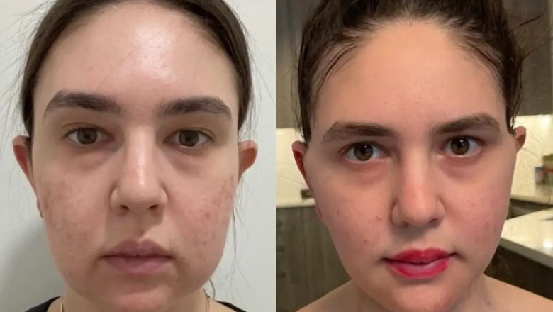 Buccal Fat Removal for a Chiseled Look: Best Doctors in Dubai Share Their Expertise