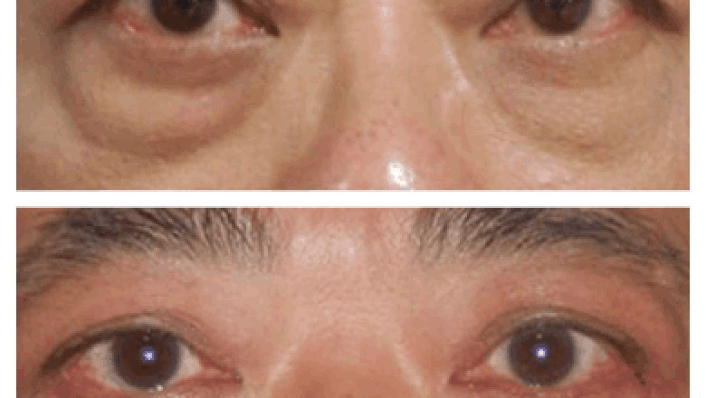 The Role of Technology in Eye Bag Removal by the Best Doctors in Dubai