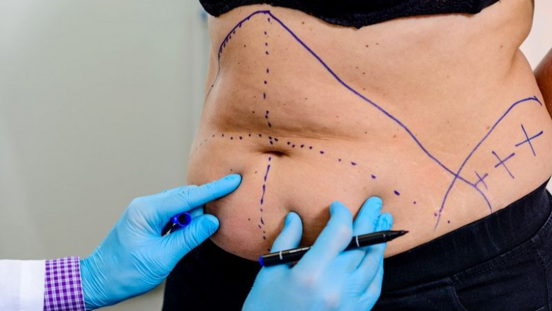 Mommy Makeover in Dubai: How to Choose the Right Clinic for Your Mommy Makeover Procedure
