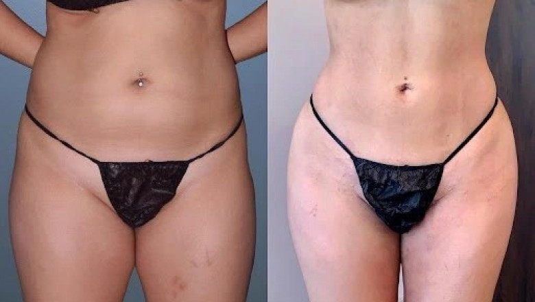 Recover and Sculpt Why Compression Wear Is Essential After Liposuction in Dubai