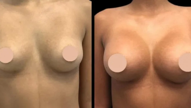 The Role of Consultation in Planning for breast augmentation in Dubai