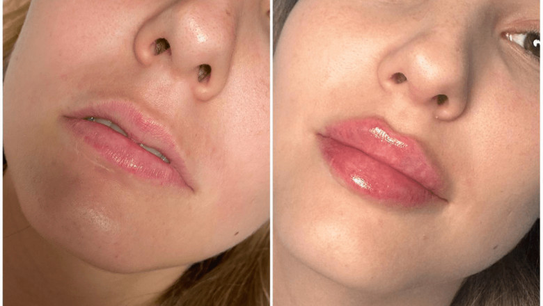 Best Age to Start Juvederm treatment in Dubai