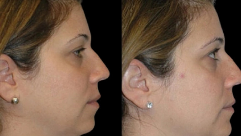 Best Exercises After Double chin removal Surgery in dubai