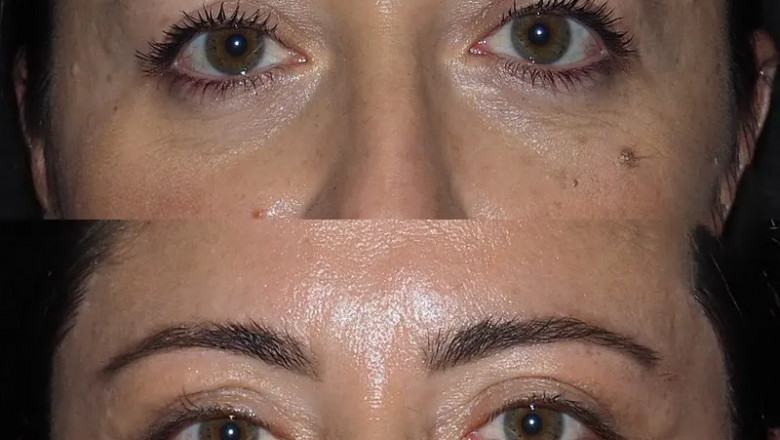 Eye bag removal Surgery in dubai: When is the Best Time to Get It Done?