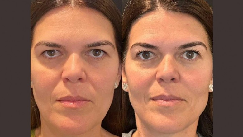 How to Prepare for Your Thread Lift Treatment in Dubai: A Step-by-Step Guide