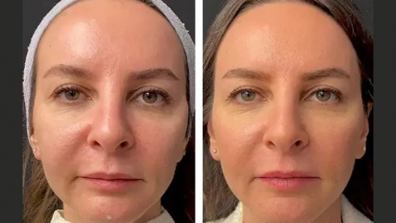 What to Expect from Your First Mesotherapy Treatments in Dubai