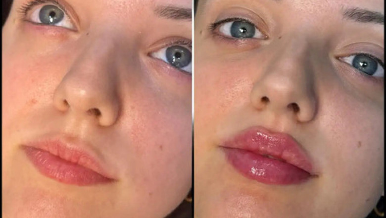 What You Should Know About Fillers Treatments in Dubai