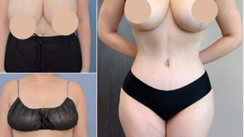 Discover the Best Tummy Tuck Surgeons in dubai for Your Procedure