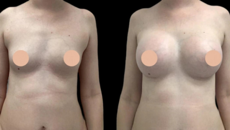 Breast Augmentation in Dubai: How Cultural Shifts Are Changing Aesthetics
