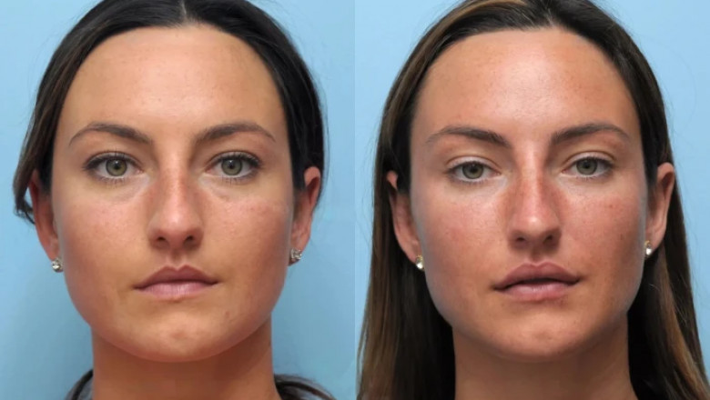 Everything You Need to Know About Thread Lift in Dubai