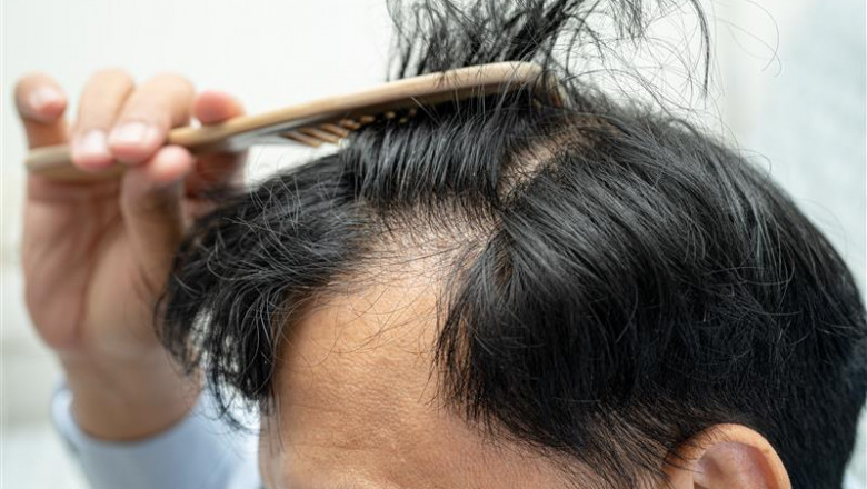 How Poor Diet Contributes to Hair Loss? - Follicle Labs