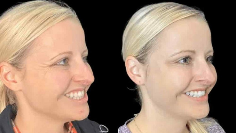Who Should Consider Botox in Dubai and Why