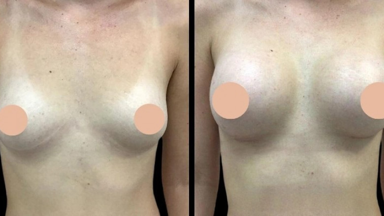 Best Breast Augmentation Surgeon in Dubai: How to Ensure a Safe and Smooth Recovery