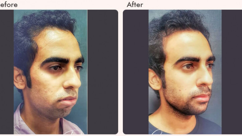 Chin implant surgery cost in Delhi
